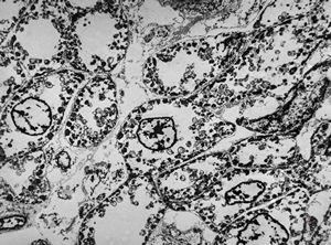 M, | newborn heart … mitochondrial cardiomyopathy … autopsy sample